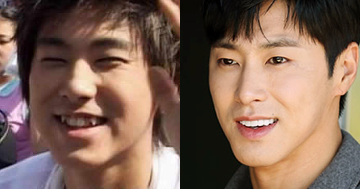 How Do Kpop Stars Have Perfect Teeth