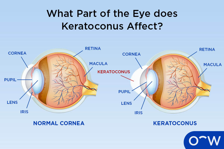 Eye Condition Starting with K