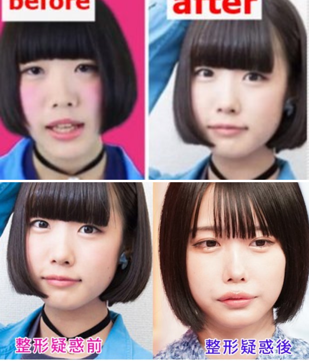 あのちゃん整形前は別人？昔の写真・卒アルと現在の変化を検証