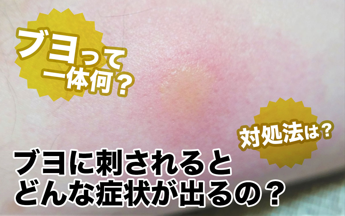2026年春夏の野外トラブル急増！「ブヨ刺され」の強烈な腫れと痒み…放置厳禁の傷跡と正しい治療法を徹底解説