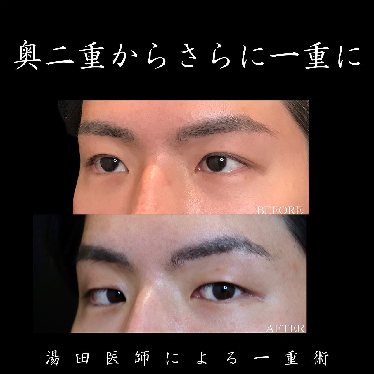 突然二重が一重になった？原因別の戻し方と危険なサイン徹底解説