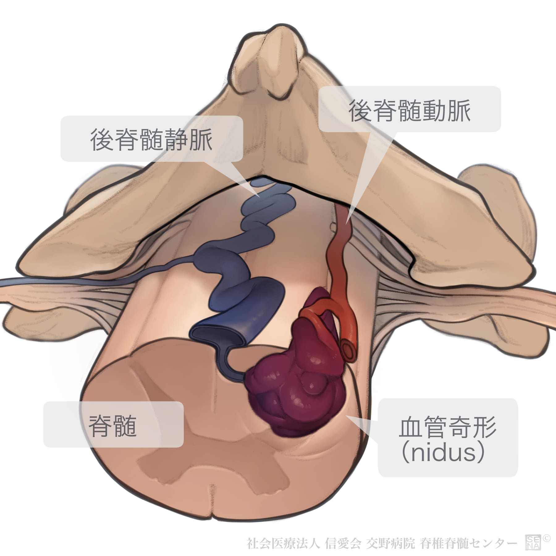 海綿状血管腫の真実｜症状・出血リスクと手術の判断基準【2026】