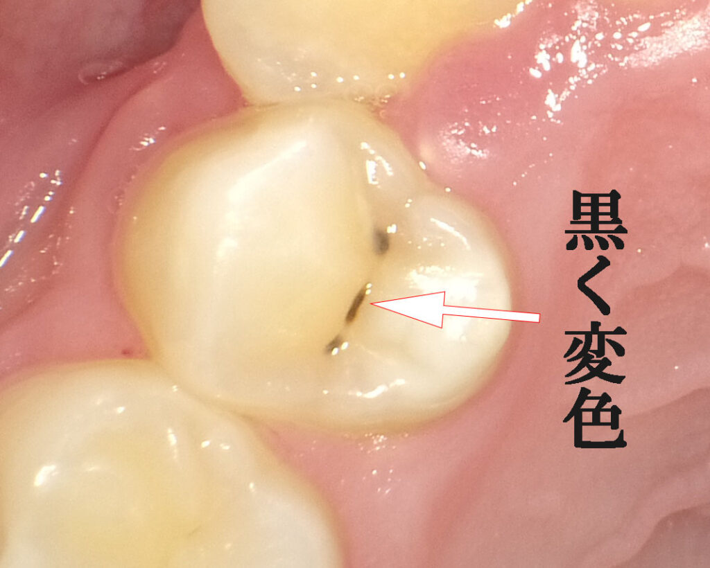 初期虫歯の黒い点は自然に治る？削らない条件と放置リスクの真相