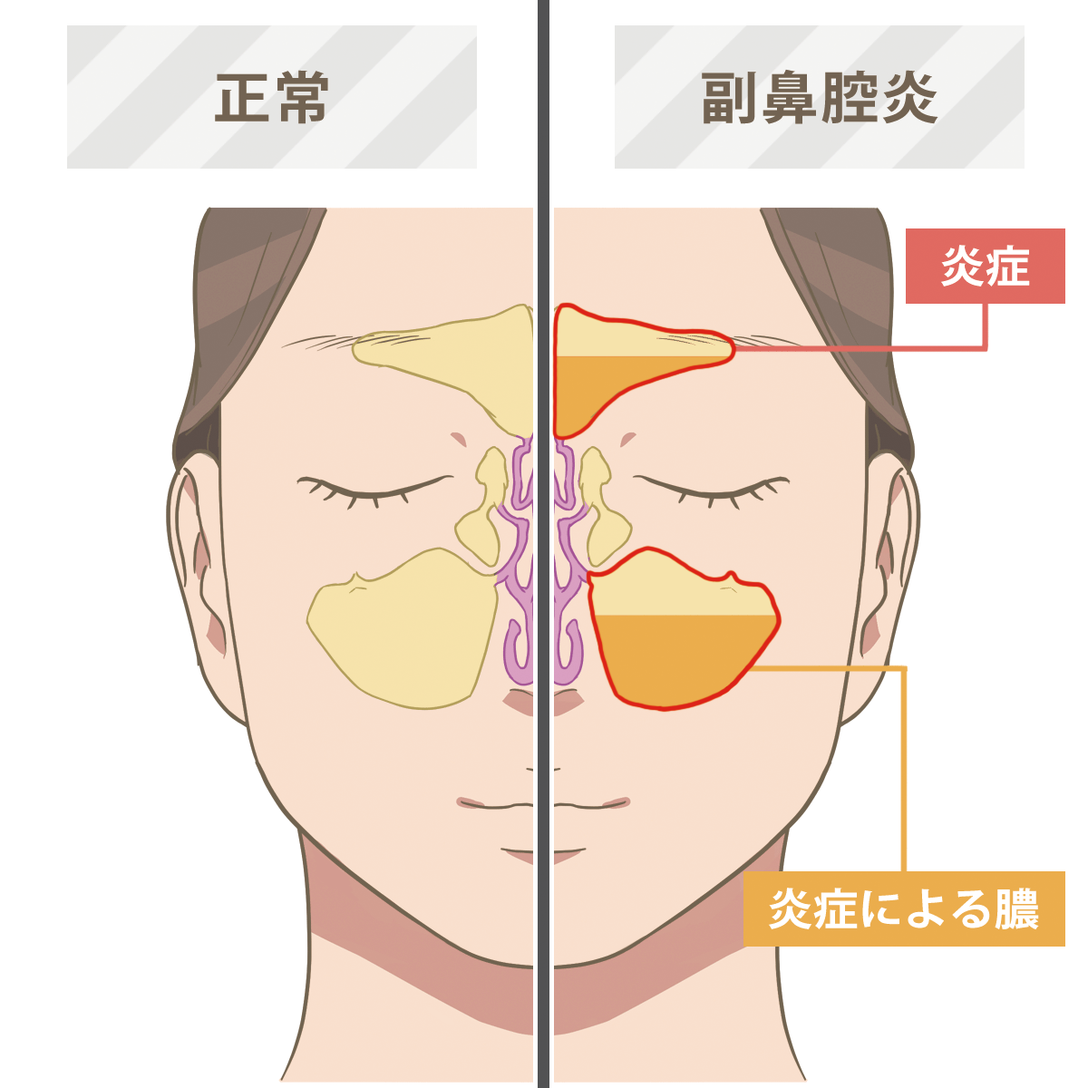 黄緑の鼻水は治りかけ？副鼻腔炎のサインと耳鼻科受診の絶対基準