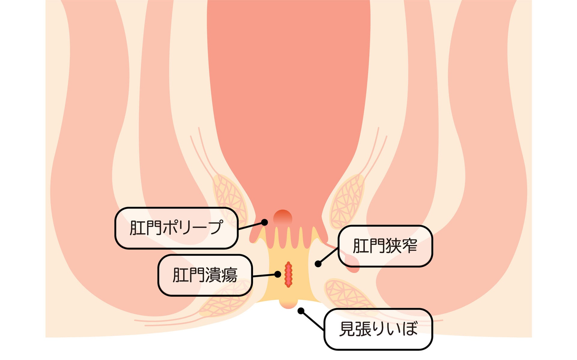 肛門皮垂は自然に治る？痔との違いや自力治療の誤解と手術費用を徹底解説