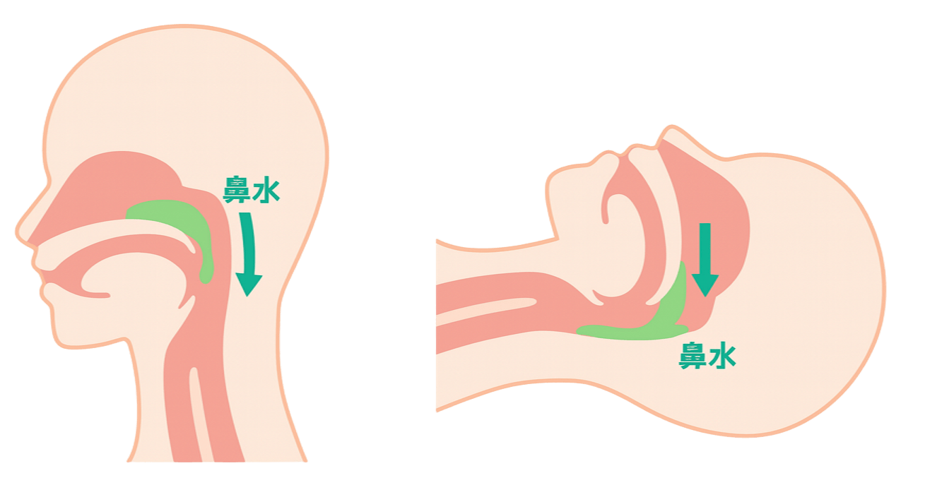 喉に鼻水が落ちる「後鼻漏」の正体｜副鼻腔炎以外の原因と治し方