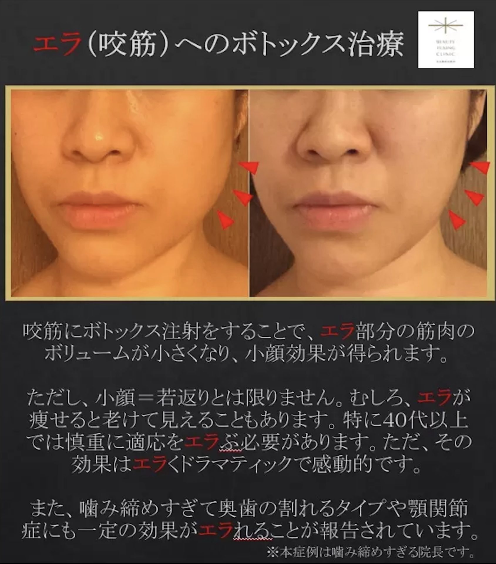 エラボトックスで老ける真相とは？頬こけ・たるみの原因と後悔を防ぐ対策