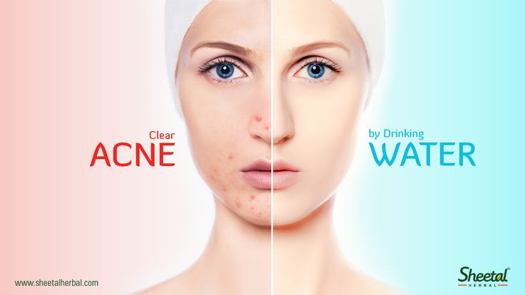 Does Not Drinking Enough Water Cause Acne