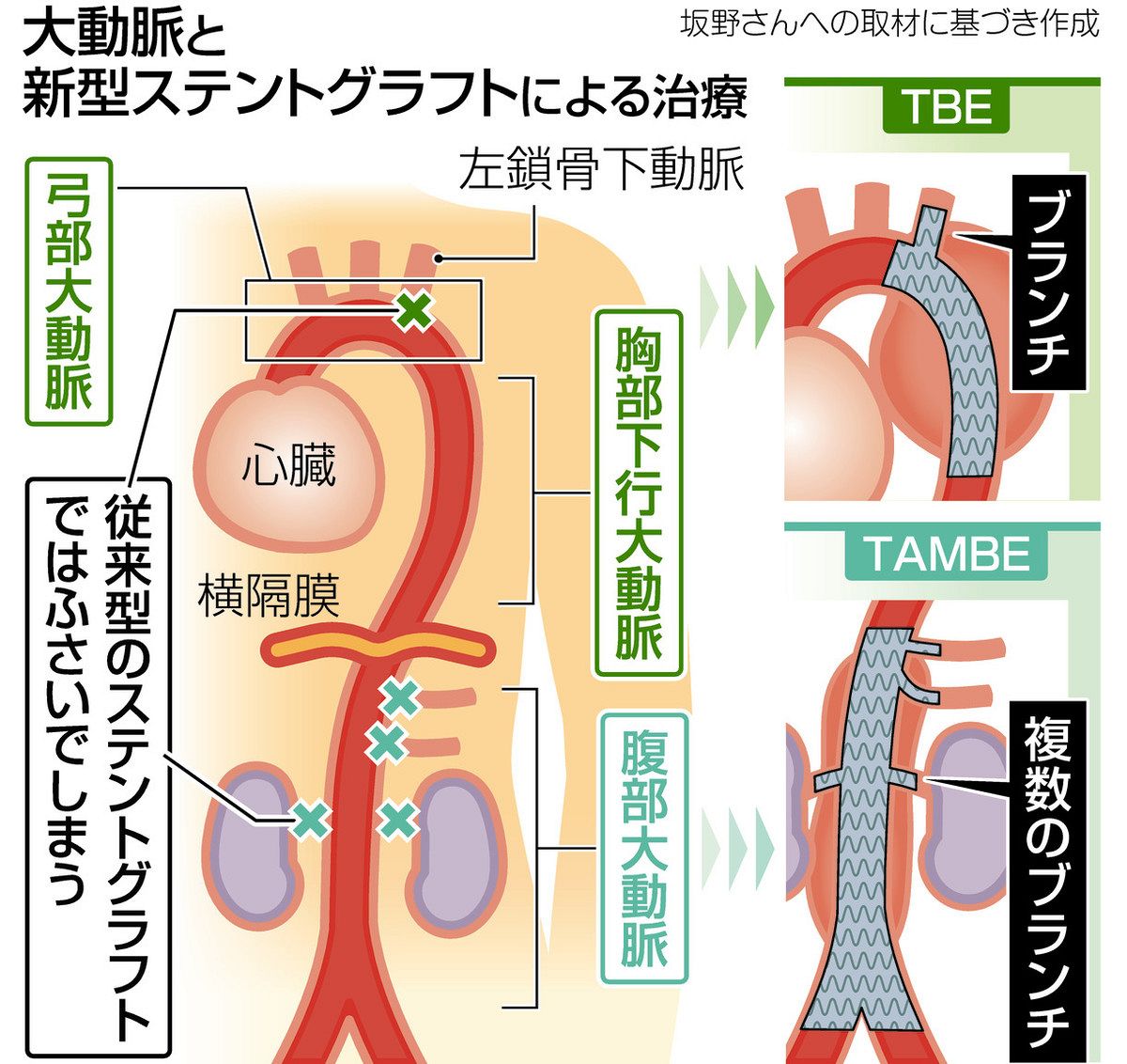 声のかすれは破裂の前兆？弓部大動脈瘤の初期症状と2026年最新治療を徹底解説