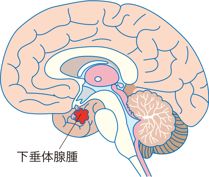 ガンバレルーヤよしこ下垂体腺腫の真相｜鼻から手術の経緯と現在の姿