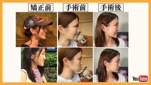【動画まとめ】 顎 変形 症 手術 芸能人 インスタライブ最新動画 #659