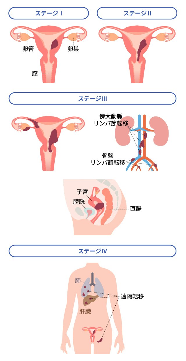 子宮体癌はエコーでわかる？見落としの真相と確定診断に必要な検査の全貌
