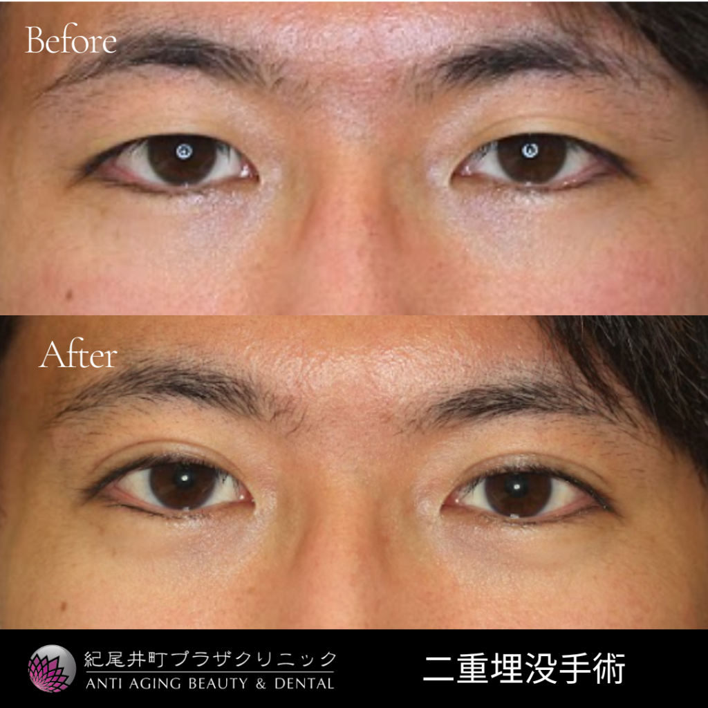 目を大きくする方法の真実｜自力ケアの限界と劇的変化の条件を検証