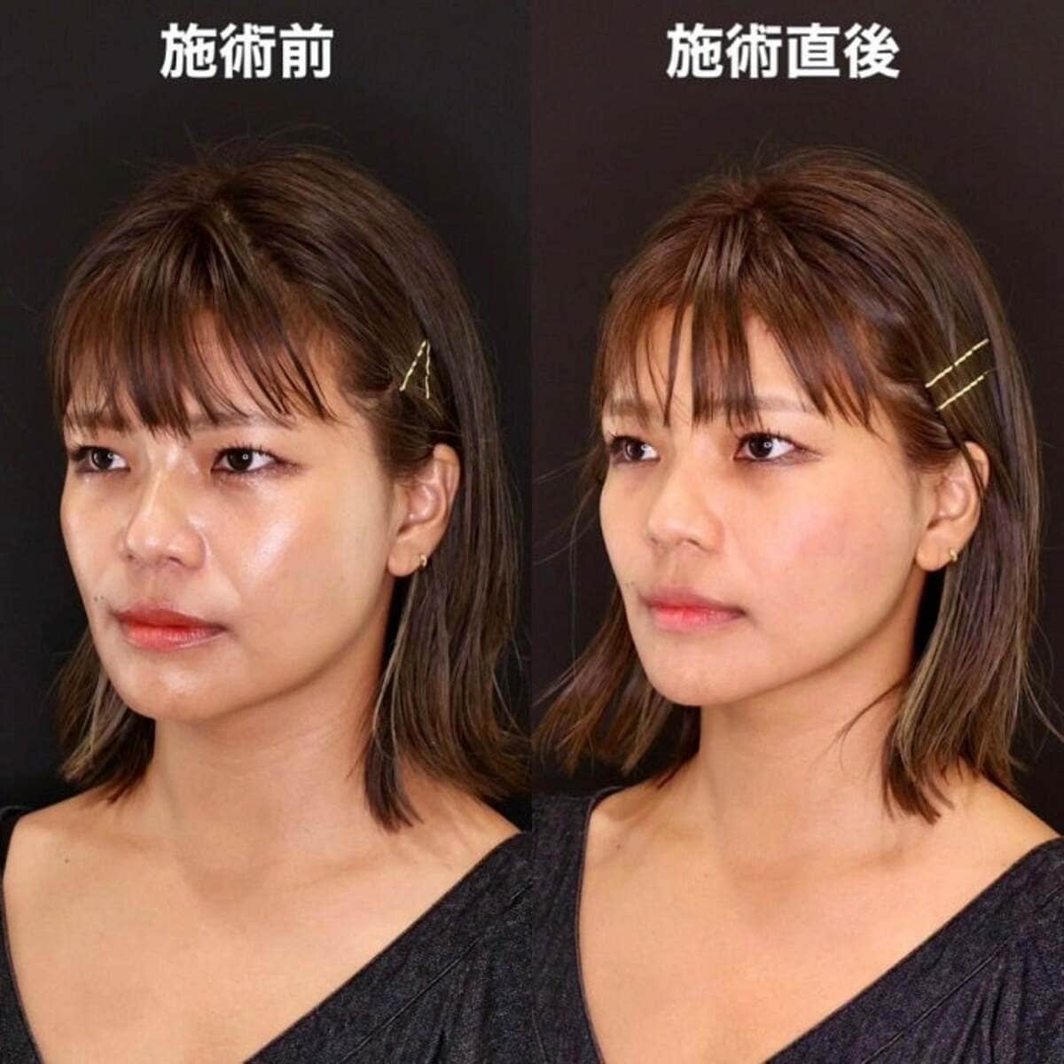 あいのりクロの整形箇所と現在！二重埋没やクマ取りの全貌を徹底検証