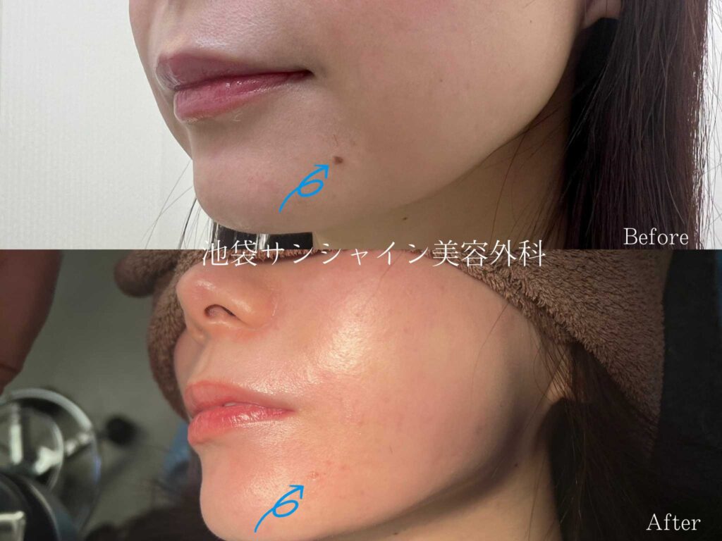 ほくろに毛が生える原因と抜いてはいけない理由｜がんとの見分け方と対策