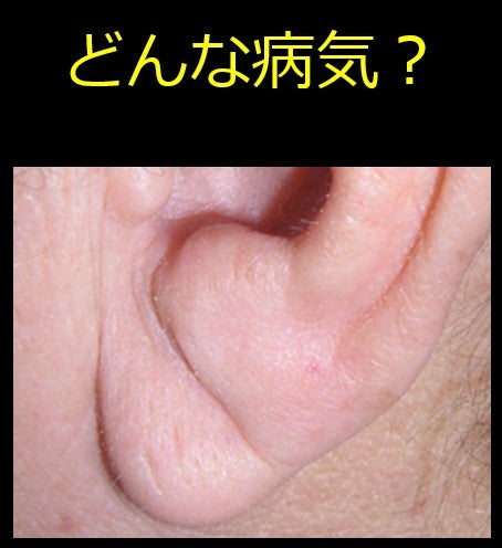 鏡の前の盲点？耳たぶの「謎の線」が警告する心臓の危機と最新の予防医学