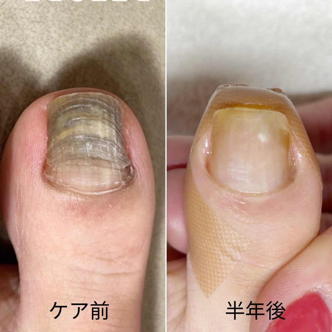 足の爪が黒いのはカビ？症例画像で見分ける原因と危険なサイン