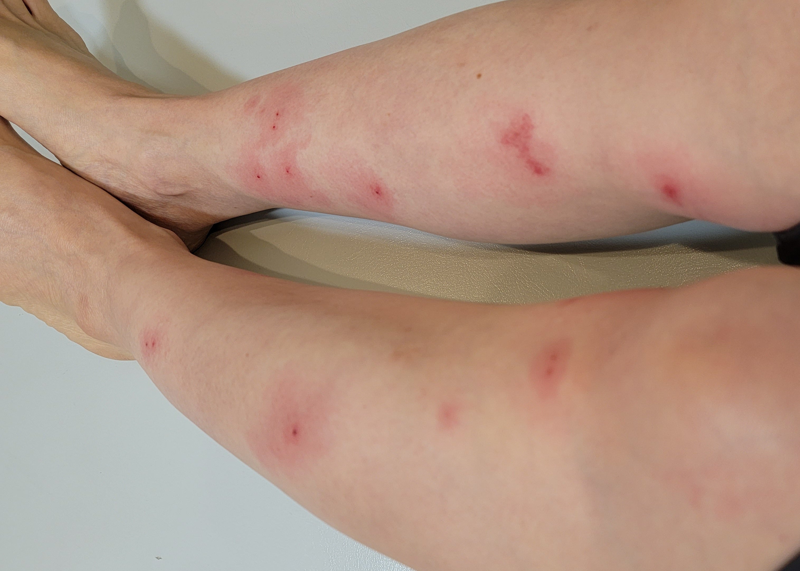 ブヨに刺されたら？激痛と腫れを防ぐ正しい応急処置と市販薬