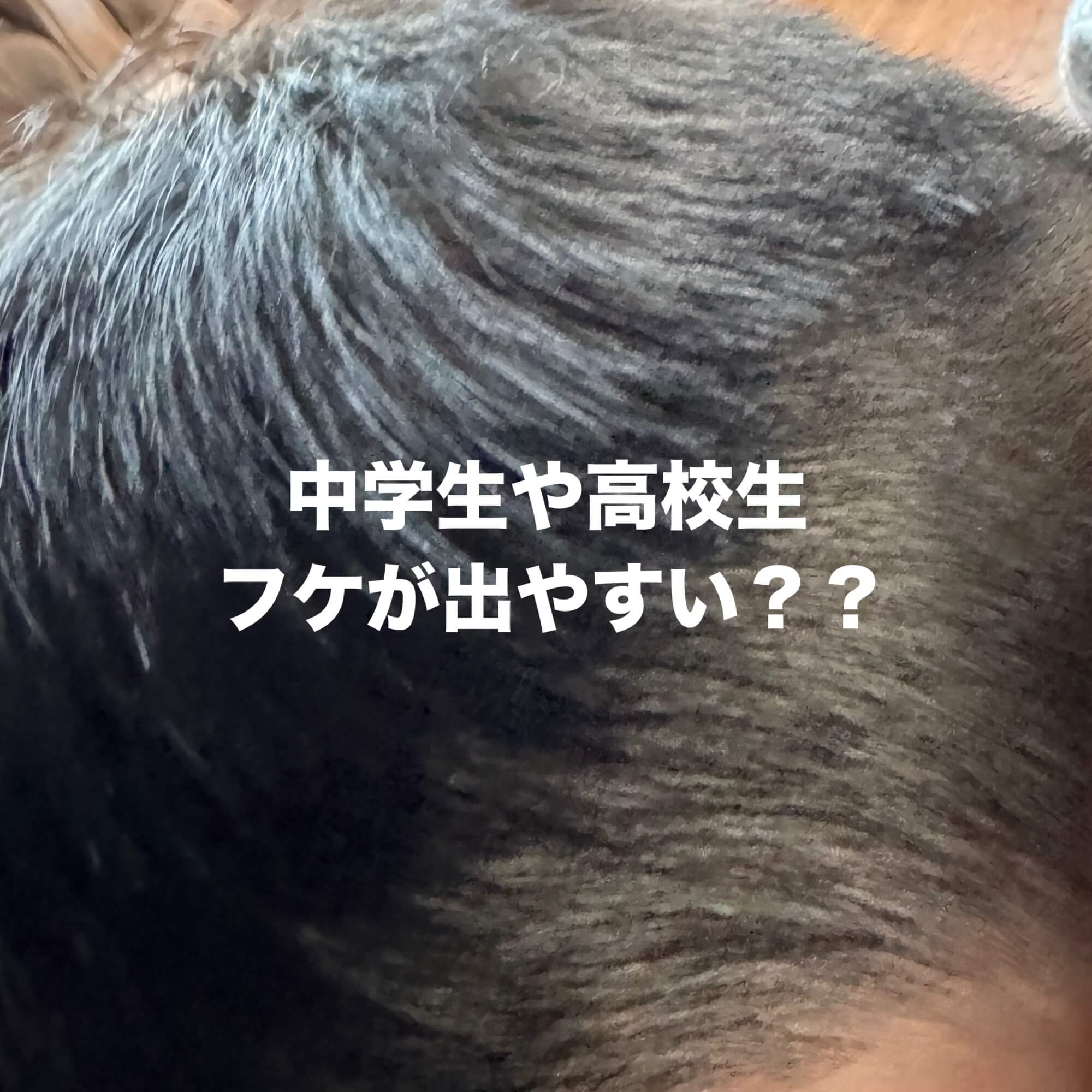 毎日洗っても中学生のフケが治らない理由と今すぐできる正しい治し方