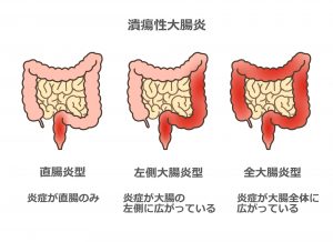 【熱愛】 潰瘍 性 大腸 炎 芸能人 徹底解説＆真相まとめ #722