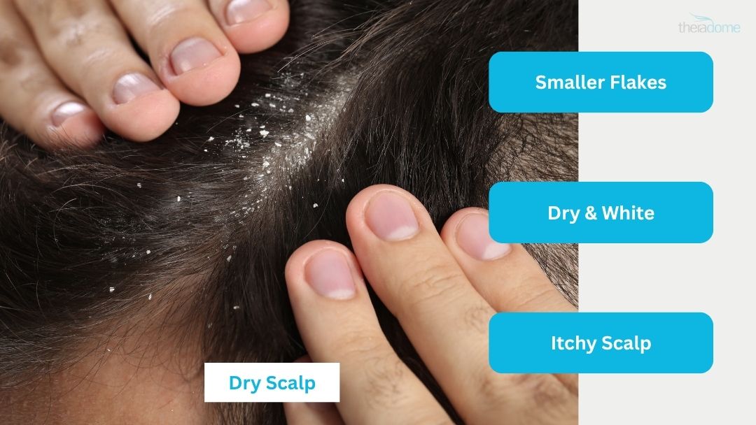 What Does Dry Scalp Feel Like