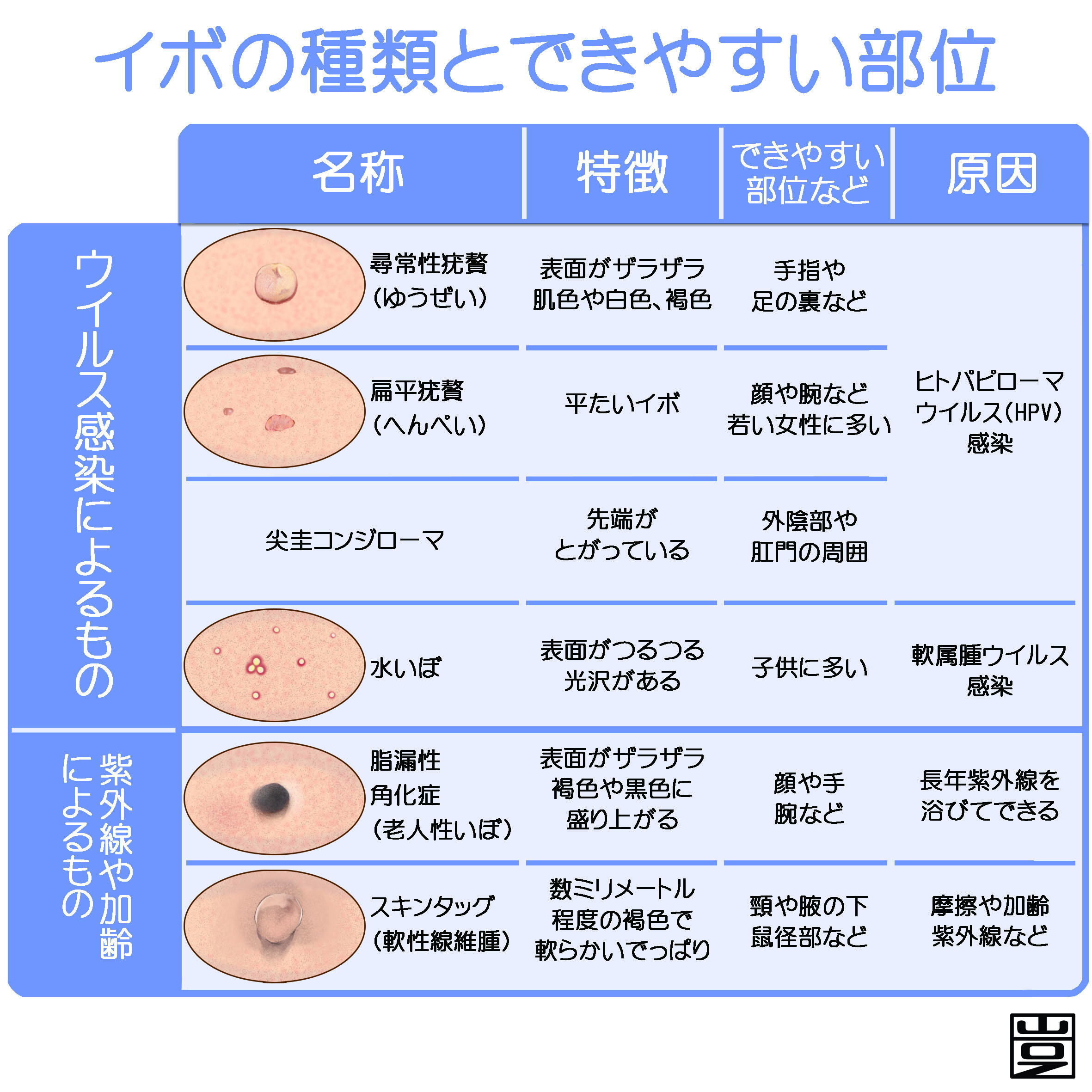 足の裏のイボを魚の目と誤認？放置で増殖する危険と最新治療法