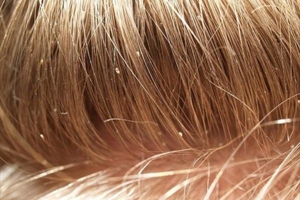 Blonde Early Lice in Hair
