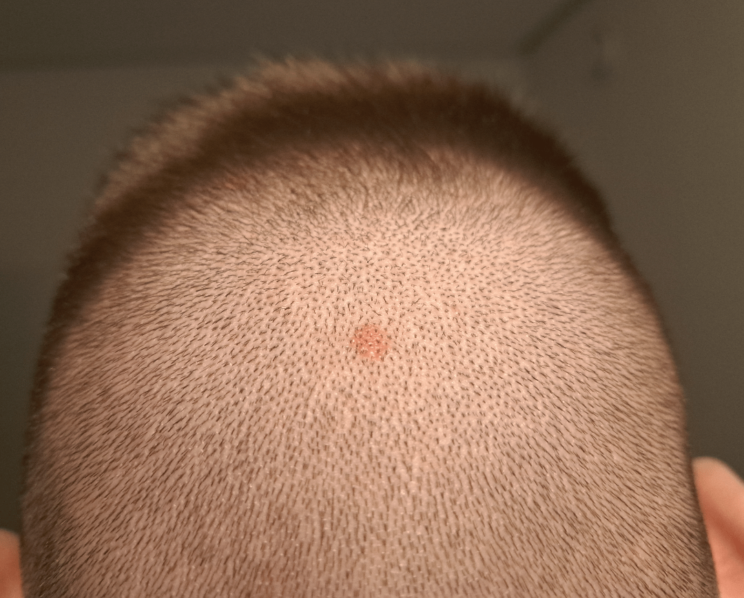 Spot Back of Head